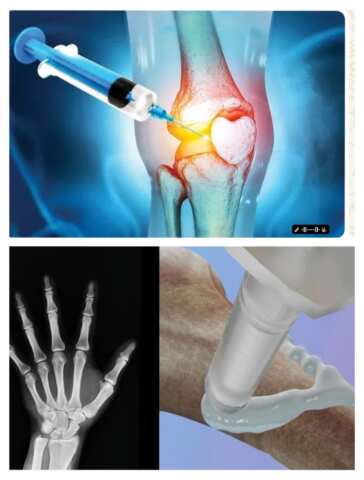 ఎముకల ఫ్రాక్చర్లను 3 నిమిషాల్లో అతికించే ‘బోన్ గ్లూ