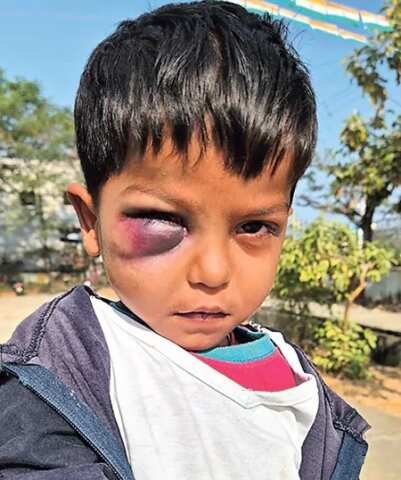 అల్లరి చేస్తున్నాడని బాలుడి కన్ను పోయేలా కొట్టిన అంగన్వాడీ టీచర్