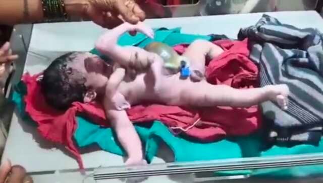 4 కాళ్లు, 4 చేతులతో జన్మించిన  మగ శిశువు.