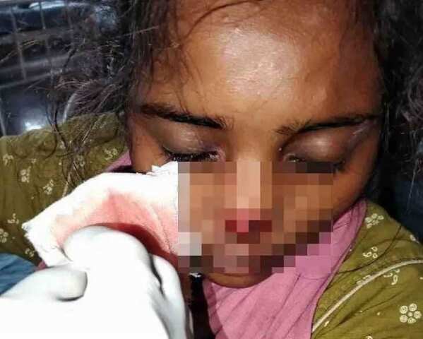 భార్య ముక్కు కొరికిన భర్త.